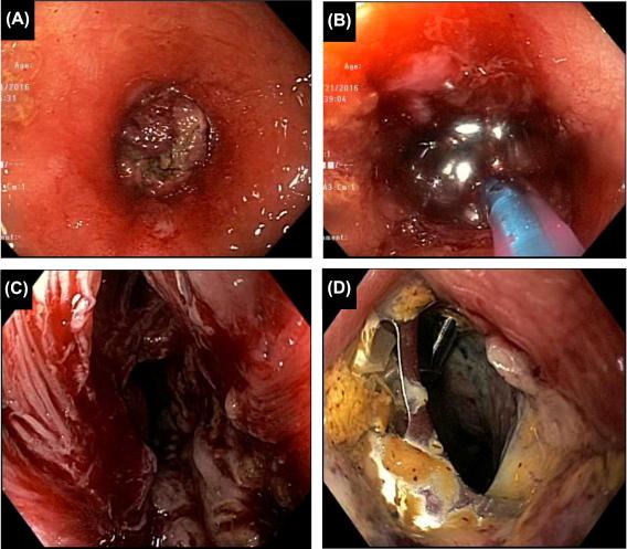 Figure 29.2, Perforation from balloon dilation of ileorectal anastomotic stricture and rescue therapy. (A) A tight fibrotic stricture; (B) balloon dilation with a size of 20 mm; (C) an iatrogenic perforation; (D) deployment of an over-the-scope clip, viewed 24 h later.