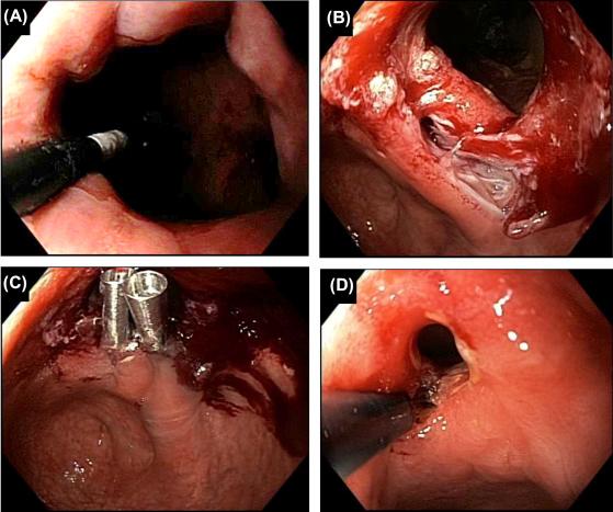 Figure 29.3, Prophylactic endoclip placement. (A) Balloon dilation of ileorectal anastomosis stricture; (B) a deep tear from the dilation; (C) prophylactic placement of endoclips to prevent full-thickness perforation; (D) rescuing endoscopic stricturotomy for the recurrent stricture 2 weeks later, which was considered relative contraindication for endoscopy balloon redilation.