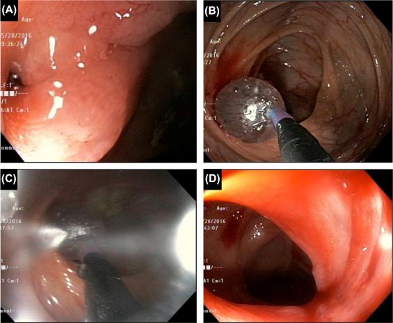 Figure 29.4, Deep tear by ruptured balloon. (A) A tight ileocecal valve stricture; (B) balloon dilation of the stricture; (C) ruptured balloon during insufflation; (D) the tear at the side of ruptured balloon.