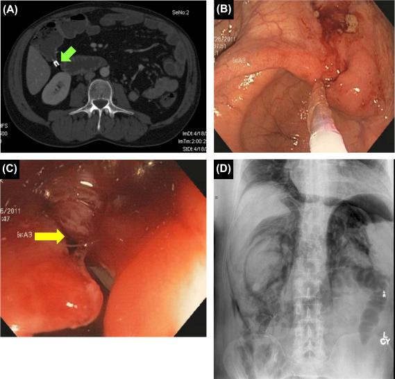 Figure 29.5, Perforation from balloon dilation of stricture of stapled ileocolonic anastomosis. (A) A tight stricture at the stapled anastomosis ( green arrow ); (B) balloon dilation; (C) deep tear without obvious perforation seen from endoscopy side ( yellow arrow ); (D) timely abdominal imaging reviewed bowel perforation resulting in proper endoscopic reintervention with endoclips.