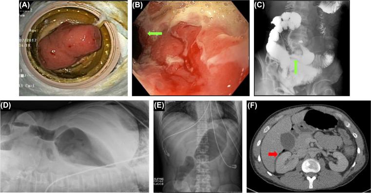 Figure 29.6, Appropriate diagnosis of endoscopic perforation. (A) The patient with a loop ileostomy; (B) stricture at 10 cm from stoma at fascia level, which is prone to fistula and stricture ( green arrow ); (C) the stricture on gastrografin enema via stoma ( green arrow ); (D and E) abdominal pain and distention after balloon dilation of the stricture prompted plain abdominal X-ray, which showed no perforation; (F) small quantify of extraluminal air ( red arrow ).