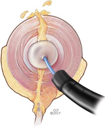 Figure 29.7, Artist depiction of mesenteric and antemesenteric perforation from endoscopic balloon dilation.