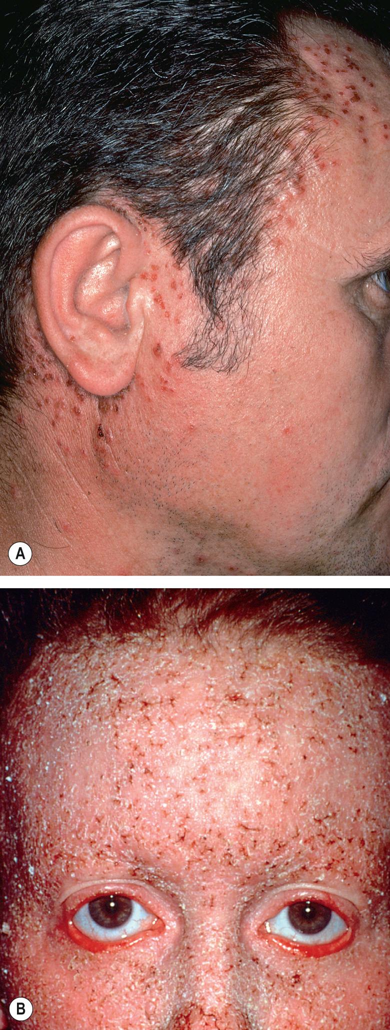 Fig. 59.3, Darier disease.