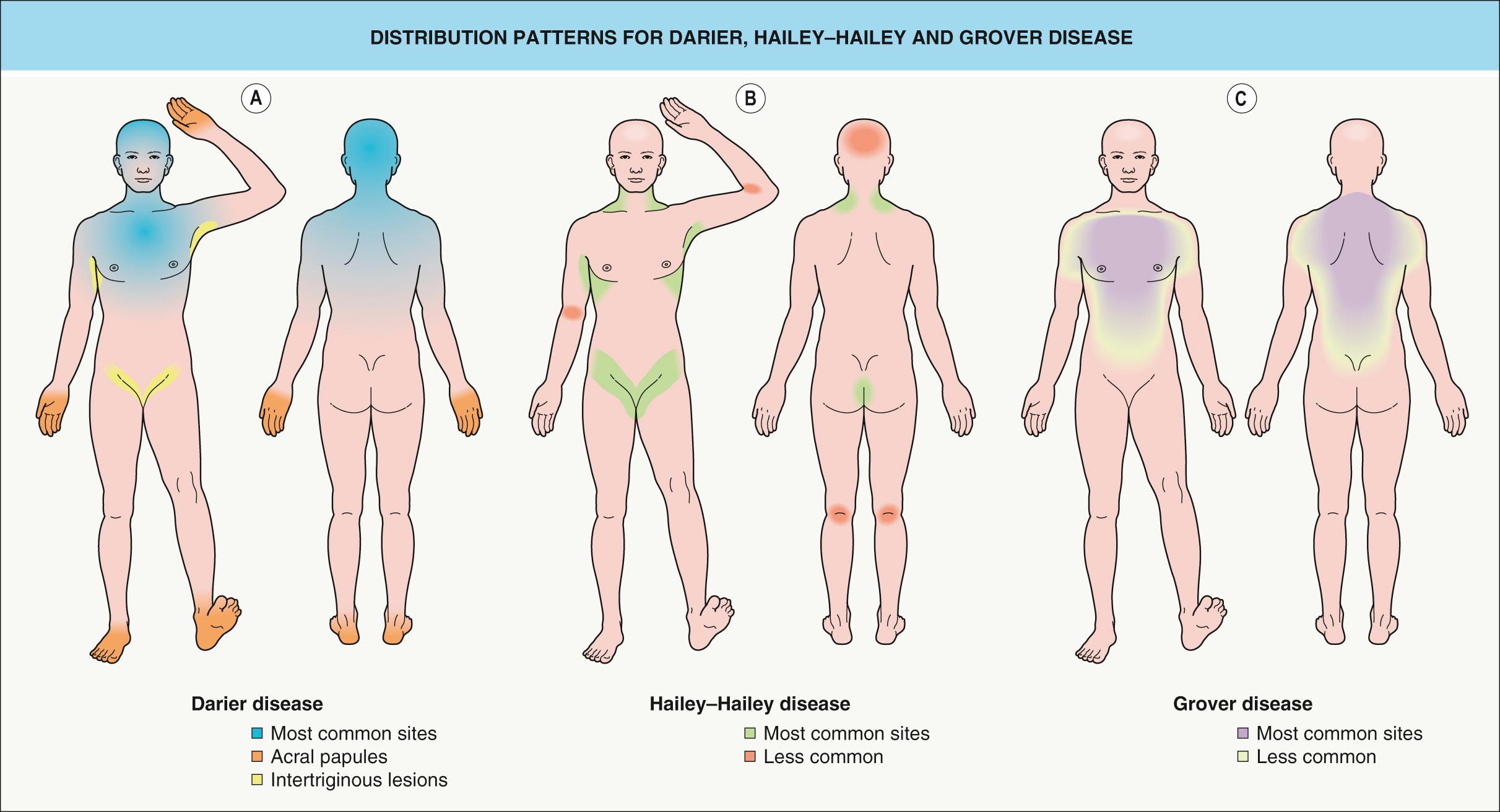 Fig. 59.4, Distribution patterns for Darier, Hailey–Hailey and Grover disease.