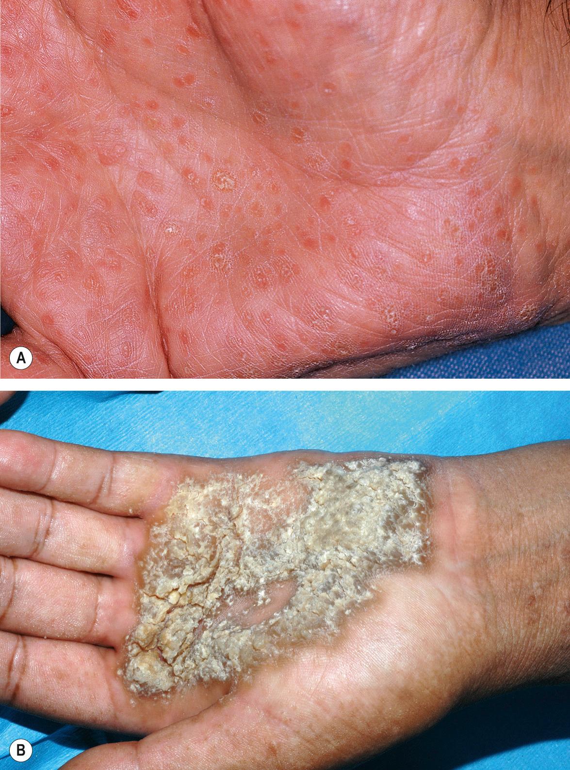 Fig. 59.8, Palmar involvement in Darier disease.