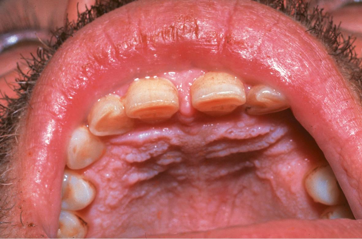 Fig. 59.10, Oral mucosal Darier disease.