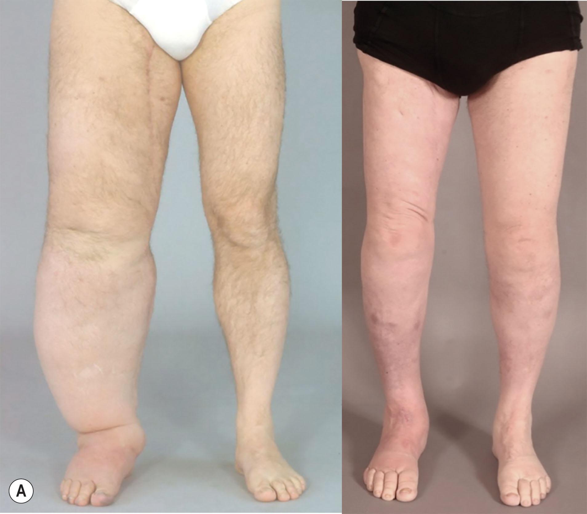 Figure 3.5.2, (A) Preoperative excess volume 5380 mL (left). Postoperative result after 3 years where excess volume is −255 mL, i.e., the treated leg is somewhat smaller than the normal one (right). (B) Preoperative excess volume 6630 mL (left). Postoperative result after 2 years with complete reduction (right).