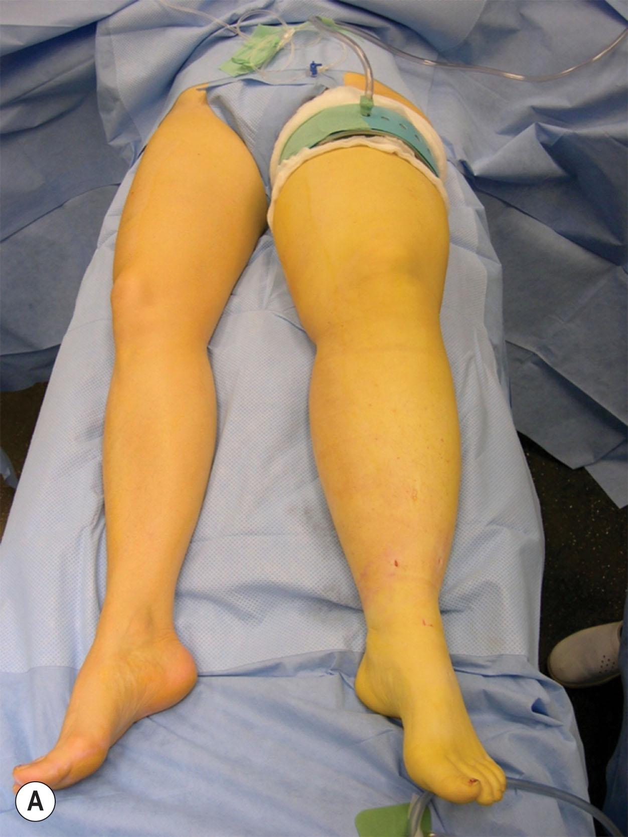 Figure 3.5.3, (A) Primary lymphedema of 4940 mL before liposuction. (B) After liposuction up to the tourniquet.