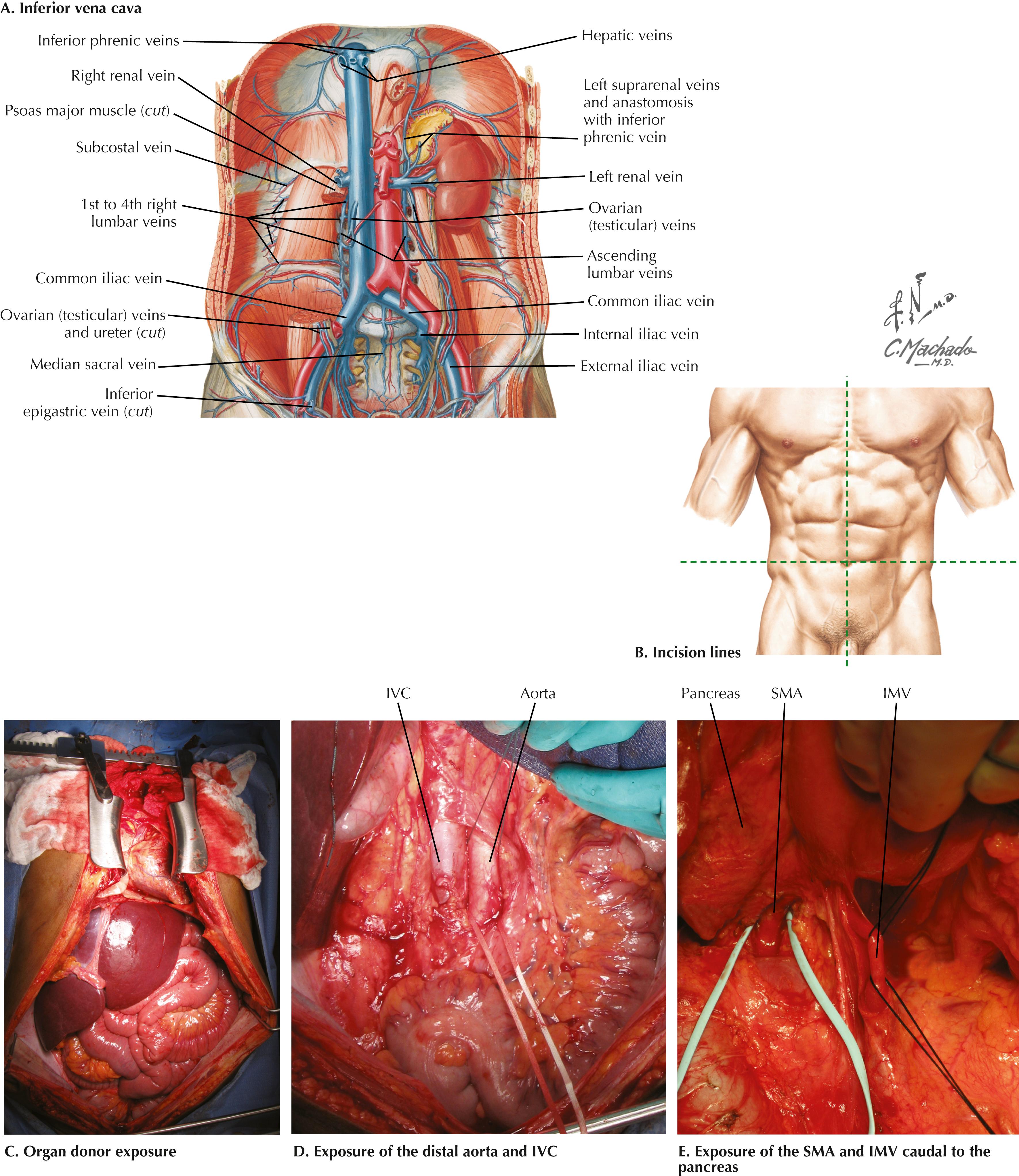 FIGURE 24.1, Abdominal anatomy and organ procurement exposures.