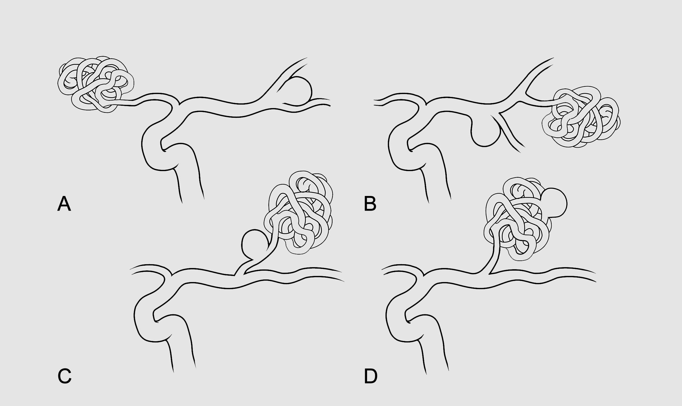 Fig. 12.1, Schematic illustration of various types of iAVM-associated aneurysms. ( A ) An aneurysm unrelated to the nidus located contralateral to the side of the nidus. ( B ) A proximal flow-related aneurysm on a main intracranial vessel up to its primary bifurcation (i.e., internal carotid artery, basilar artery, M 1 segment of the middle cerebral artery, A 1 segment of the anterior cerebral artery) or the circle of Willis, including posterior and anterior communicating arteries. ( C ) A distal flow-related aneurysm located on a feeding artery supplying the AVM nidus. ( D ) An aneurysm located within the nidus of the AVM.