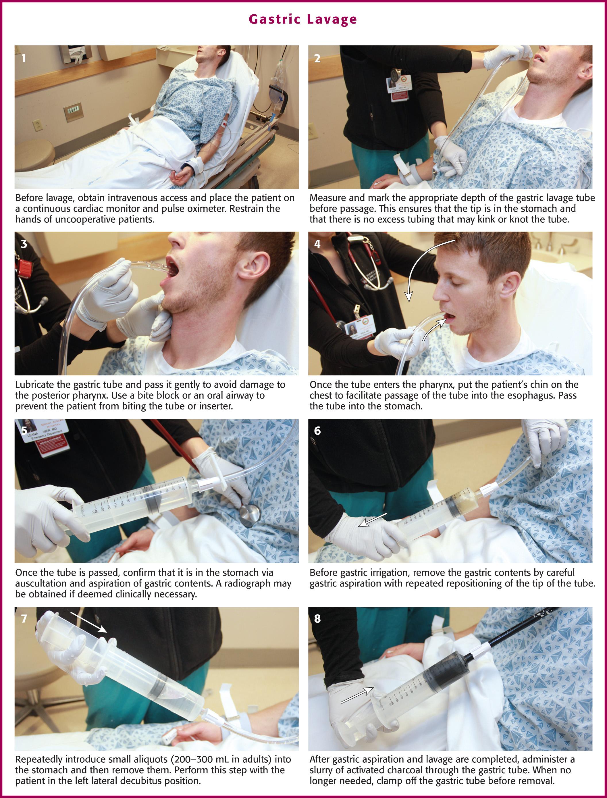 Figure 42.2, Gastric lavage. In an awake patient the orogastric tube can be passed with the patient in the sitting position, but the lavage procedure is best performed with the patient in the left lateral decubitus position.