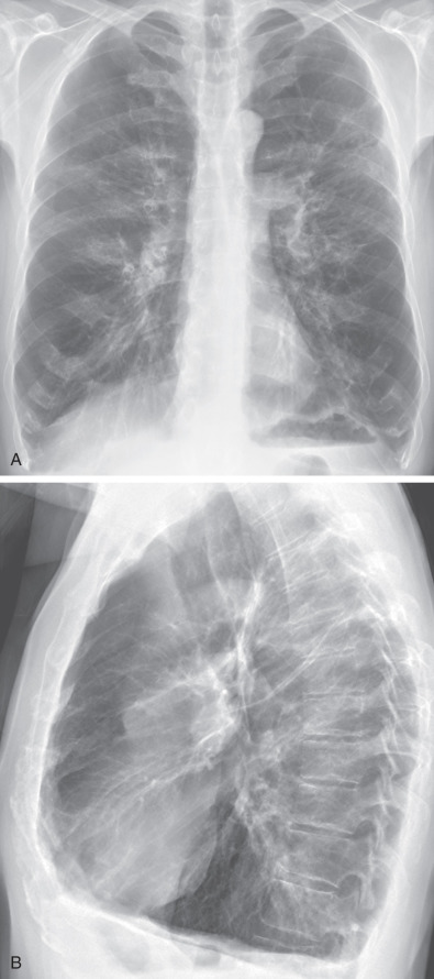 Fig. 6.2, Hyperinflation from panlobular emphysema associated with α1-antitrypsin deficiency. (A) Posteroanterior chest radiograph shows that the dome of the right hemidiaphragm is below the level of the anterior right seventh rib, consistent with increased lung volumes. Note a decrease in peripheral vascular markings. (B) Lateral view demonstrates increased retrosternal clear space (>2.5-cm distance between the posterior sternum and the most anterior margin of the ascending aorta) and flattening of the hemidiaphragms.
