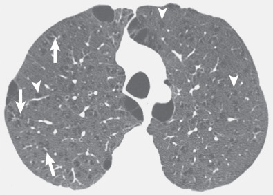 Fig. 6.3, Centrilobular and paraseptal emphysema. High-resolution CT at the level of the upper lobes shows foci of low attenuation (arrowheads) characteristic of centrilobular emphysema. Vessels (arrows) can be seen within some of the areas of emphysema and is termed the centrilobular dot sign. Note foci of emphysema greater than 1 cm in diameter (bullae) in the subpleural regions, characteristic of paraseptal emphysema. Some of the bullae have thin walls.