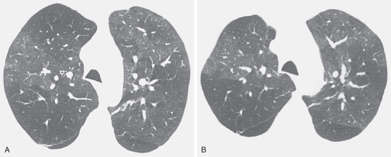 Fig. 6.4, Mosaic attenuation in asthma. (A) High-resolution CT performed at end inspiration shows extensive areas of decreased attenuation and vascularity, with redistribution of blood flow to normal lung resulting in a mosaic attenuation pattern. (B) High-resolution CT performed after maximal expiration demonstrates extensive bilateral air trapping.