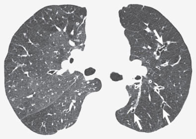 Fig. 6.5, Constrictive bronchiolitis associated with rheumatoid arthritis. High-resolution CT shows decreased attenuation and vascularity in most of the left lung, the anterior aspect of the right upper lobe, and the superior segment of the right lower lobe. Also noted is bronchiectasis (arrows). The findings are characteristic of constrictive bronchiolitis. The uninvolved portions of the right upper lobe have increased vascularity and attenuation because of redistribution of blood flow. The heterogeneous pattern of attenuation and vascularity is known as mosaic attenuation.