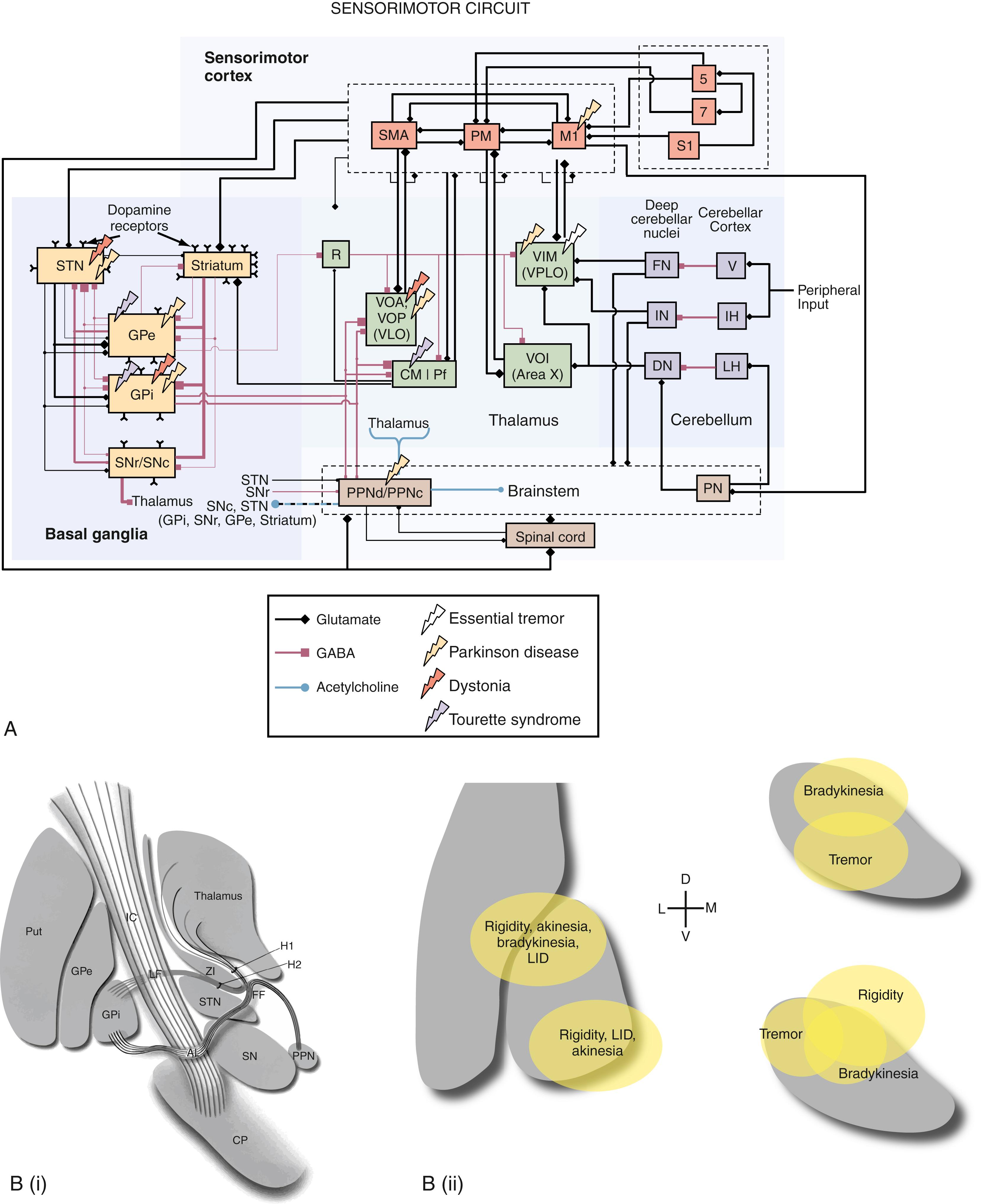 Figure 113.1, (A) Schematic representation of the basal ganglia–thalamocortical circuit connections. Targets for deep brain stimulation (DBS) therapy are identified by lightning bolts. The target chosen depends on the neurological disorder being treated. Of interest, stimulation of multiple targets can be effective for a particular disorder, which emphasizes the role of network malfunction in the pathophysiologic processes of neurological disorders. In the sensorimotor circuit, the line color and terminal shape represent the primary neurotransmitter involved in the signaling pathway. (B, i) Representation of major anatomic structures and fiber pathways associated with the STN and GPi. (B, ii) Representation of stimulation targets within and near the GPi and STN that have been found to have differential effects on individual parkinsonian motor symptoms. DBS in the dorsal GPi, including the medial medullary lamina and portions of the GPe, have been shown to ameliorate rigidity, akinesia, and bradykinesia but worsen levodopa-induced dyskinesia (LID), whereas stimulation in the ventral GPi improved rigidity and decreased LID but worsened akinesia. 63 , 288 289 290 With regard to the STN, one study revealed that targeting dorsal-anterior and ventral-posterior locations was optimal for relieving bradykinesia andtremor, respectively. 291 Another study revealed that the most efficacious stimulation sites for tremor, bradykinesia, and rigidity fell into slightly different regions of the superolateral (motor) STN. 294 The effective region for rigidity was largest, extending beyond the STN to include the zona incerta (ZI) and fields of Forel (FF). 5, 7, Brodmann areas; AL, ansa lenticularis; CM, centromedian nucleus; CP, cerebral peduncle; DN, dentate nucleus; FN, fastigial nuclei; GABA, γ-aminobutyric acid; GPe, external globus pallidus; GPi, internal globus pallidus; H1, H1 field of Forel (thalamic fasciculus); IC, internal capsule; IH, intermediate hemisphere of the cerebellum; IN, interposed nuclei; LF, lenticular fasciculus (H2); LH, lateral hemisphere of the cerebellum; M1, primary motor cortex; Pf, parafascicular nucleus; PM, premotor cortex; PN, pontine nucleus; PPN, pedunculopontine nucleus; PPNc, pedunculopontine nucleus pars compacta; PPNd, pedunculopontine nucleus pars diffusa; Put, p utamen; R, reticular formation; S1, primary somatosensory cortex; SMA, supplementary motor area; SN, substantia nigra; SNc, substantia nigra pars compacta; SNr, substantia nigra pars reticularis; STN, subthalamic nucleus; V, vermis; VIM, ventral intermediate nucleus; VLO, ventrolateral pars oralis; VOA, anterior ventral oral nucleus; VOI, ventro-oralis internus (Olszewski area X); VOP, posterior ventral oral nucleus; VPLO, ventral posterolateral pars oralis.