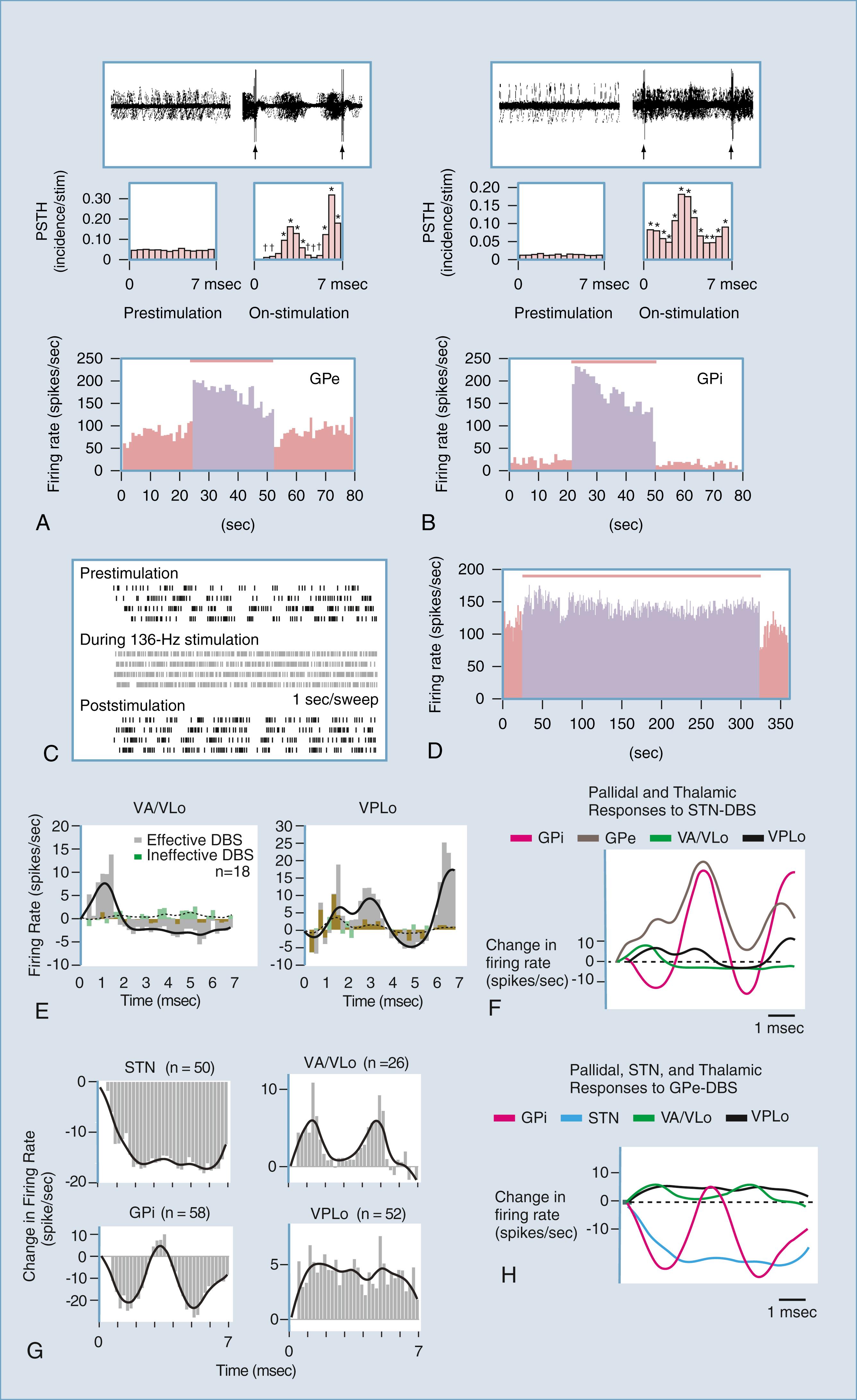 Figure 113.2, Examples of neuronal responses occurring during subthalamic nucleus (STN) deep brain stimulation (DBS) in a cell from the internal globus pallidus (GPi) (A) and a cell from the external globus pallidus (GPe) (B). Top traces show the overlay of 100 sweeps triggered at 10-millisecond intervals in the prestimulation period and by triggering on the stimulation pulse during the stimulation. Middle traces display peristimulus timing histograms (PSTH) reconstructed from successive 7.0-millisecond time intervals in the prestimulation period and from the interstimulus periods, inthe on-stimulation period. Asterisks indicate significant increase at P < .01; daggers indicate significant decrease at P < .01 (Wilcoxon signed rank test). Bottom plots represent the mean firing rate calculated in 1-second bins, which illustrate the time course of the firing rate. (C) Raster plots of GPi neuronal activity showing that firing patterns changed from irregular with varying interspike intervals into a high-frequency regular pattern during 136-Hz, 3.0-V stimulation. (D) Example of the change in firing rate of a GPi neuron during prolonged 136-Hz STN stimulation. An increased discharge rate was sustained during the 5-minute stimulation period. (E) PSTH of effective (gray) and ineffective (green) stimulation for ventralis anterior/ventralis lateralis pars oralis (VA/VLo) neurons (left) and ventrolateral preoptic nucleus (VPLo) neurons (right). In these plots, prestimulation firing rate has been subtracted to reflect change in firing evoked by stimulation in relation to baseline. The continuous line is a smoothed running average for effective stimulation, whereas the dotted line is the smoothed running average for ineffective stimulation. (F) Average PSTHs of populations of pallidal and thalamic neurons during therapeutic STN stimulation, illustrating that stimulation evokes complex temporal patterns of firing activity in these nuclei. (G) PSTHs of STN, GPi, VA/VLo, and VPLo neurons during therapeutic GPe stimulation. (H) Average PSTHs of populations of pallidal, STN, and thalamic neurons during GPe stimulation (from part G). These data support the hypothesis that therapeutic DBS activates output from the stimulated structure and changes the temporal pattern of neuronal activity throughout the basal ganglia thalamic network.