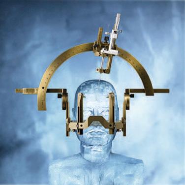 Figure 36.1, Elekta G model headframe and arc, assembled as used in deep brain stimulation surgery. The headframe ( arrow ) is secured to the skull by using sharp pins. The stereotactic images are acquired with the fiducial box loaded on the headframe. In the operating room, the arc is assembled on the headframe and set to the planned stereotactic coordinates.