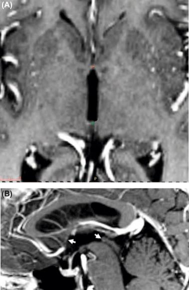 Figure 36.2, The AC ( arrowhead ) and PC ( arrow ) are shown in (A) axial and (B) sagittal views. The midpoint of the line traced between these two landmarks is the midcommissural point.