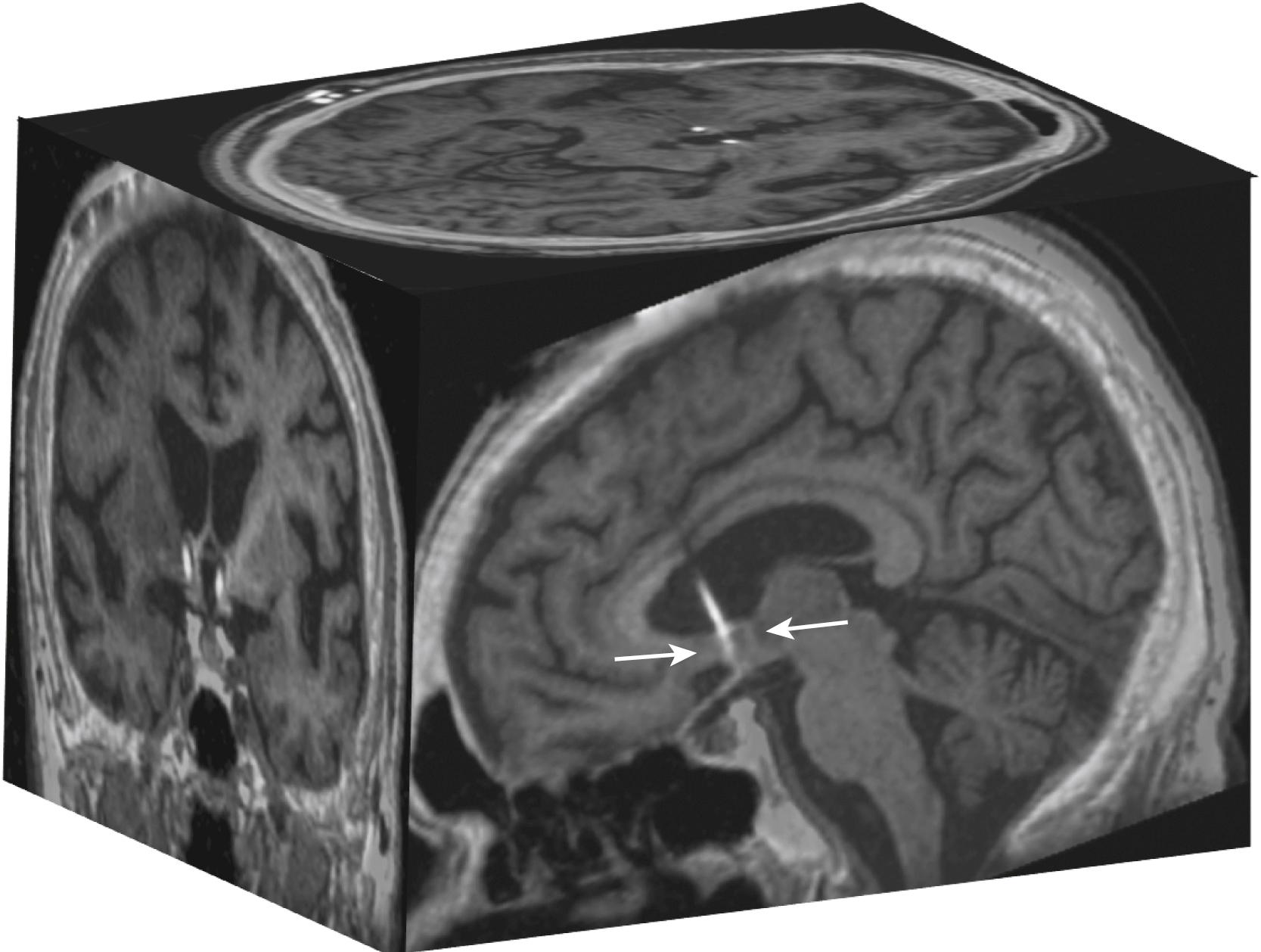 Figure 131.2, Deep brain stimulation in a patient with Alzheimer disease.