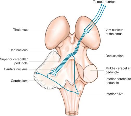 Figure 75.1, A schematic representation of the cerebellothalamic pathway, with axons of the deep cerebellar nuclei ascending to the contralateral thalamus. See text for details.