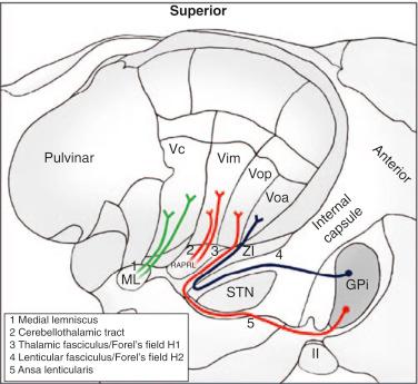 Figure 75.2, A sagittal schematic of the thalamus, showing the terminations of the medial lemniscus, cerebellothalamic pathway, and the pallidothalamic pathway on Vc, Vim, and Voa/Vop, respectively. II: optic tract. GPi , globus pallidus interna; ML , medial lemniscus; RAPRL , prelemniscal radiation; STN , subthalamic nucleus; Vc , ventralis caudalis; Vim , ventralis intermedius; Voa , ventralis oralis anterior; Vop , ventralis oralis posterior; ZI , zona incerta. See text for details.