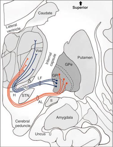 Figure 75.3, A coronal schematic demonstrating the relationships of the pallidothalamic pathway. AL , ansa lenticularis; Same key as Fig. 75.2 . GPe , globus pallidus externa. H , Forel’s field H; H1 ; Forel’s field H1; H2 , Forel’s field H2; LF , lenticular fasciculus. See text for details.