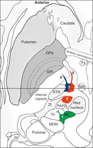 Figure 75.4, An axial schematic demonstrating the anatomy of the subthalamic area. Approximate regions for the cerebellothalamic tract (2) and the pallidothalamic tract (3) are indicated. Same key as Figs. 75.2 and 75.3 . 1/ML , medial lemniscus; 2 , cerebellothalamic tract; 3 , pallidothalamic tract; 4 , lenticular fasciculus; 5 , ansa lenticularis; Fx , fornix; MGN , medial geniculate nucleus; Mtt , mammillothalamic tract. See text for details.