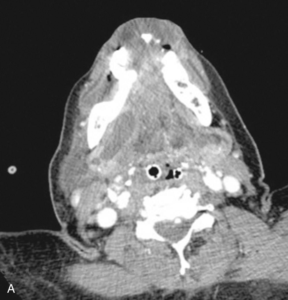 Fig. 9.1, Right floor of mouth abscess along Wharton duct from sialolithiasis as seen on axial (A) and coronal (B) CT images.