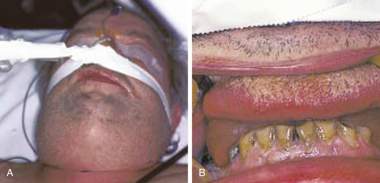 Fig. 9.4, A patient with Ludwig angina with swelling of the bilateral upper neck (A) and bilateral sublingual spaces causing the tongue to obstruct the upper airway (B).