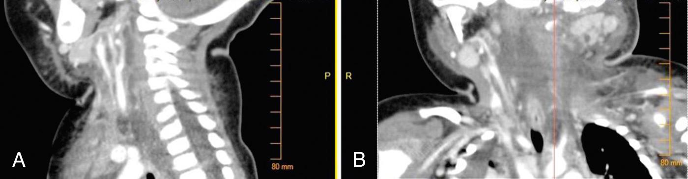 Fig. 9.6, Sagittal (A) and coronal (B) contrasted CT images in a pediatric patient demonstrating infection spreading down the carotid sheath to the mediastinum, known as the “Lincoln highway.”