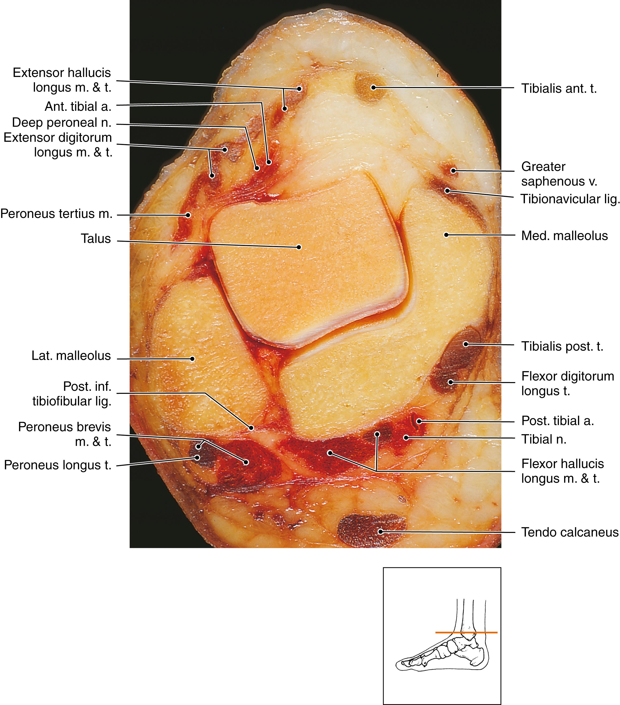 FIG. 181.2, Anatomy of the deep peroneal nerve and related structures. a. , Artery; ant. , anterior; lat. , lateral; lig. , ligament; m. , muscle; med. , medial; post. , posterior; t. , tendon; v. , vein.