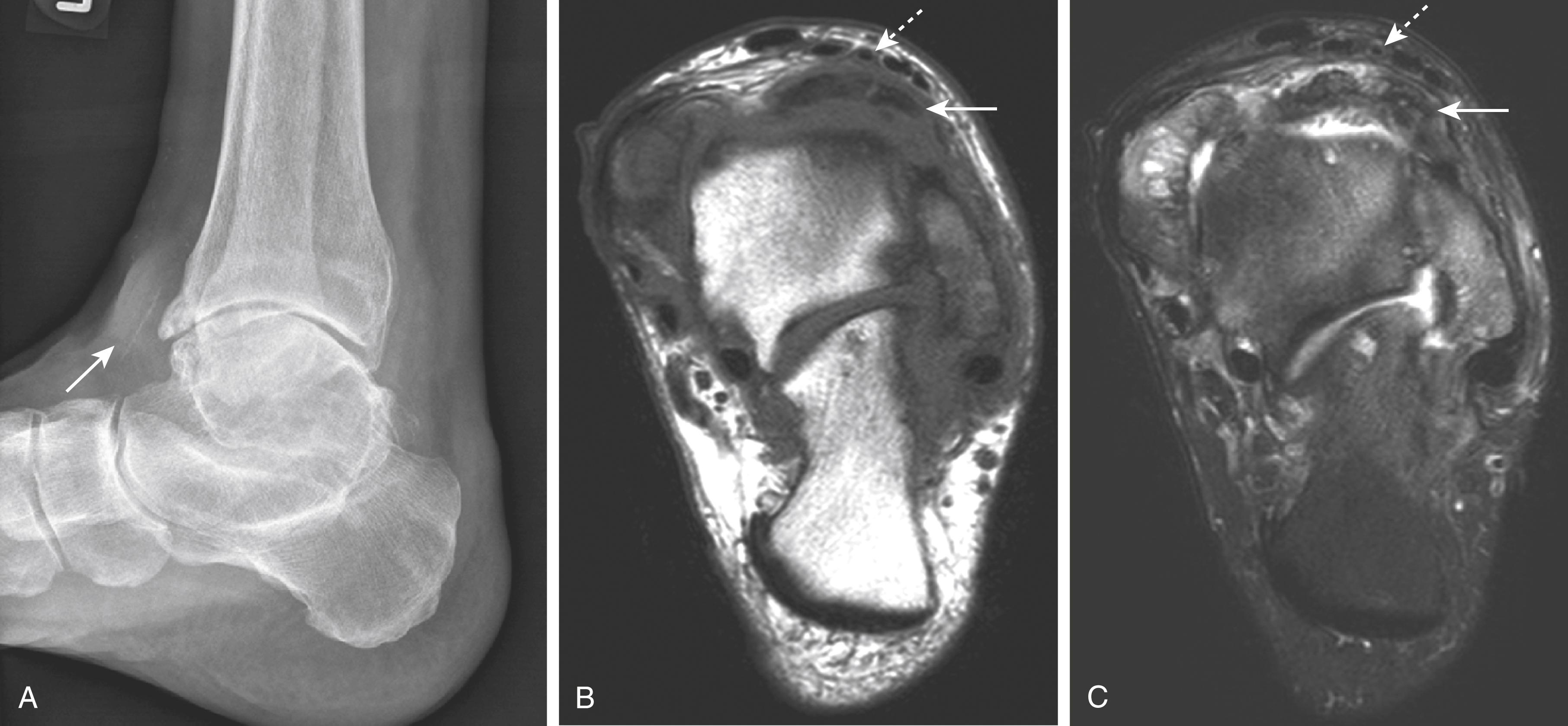 FIG. 181.3, A, Lateral radiograph of a patient with osteoarthritis of the ankle and subtalar joint. There is prominent anterior osteophyte formation at the anterior aspect of the joint with associated soft-tissue shadowing (white arrow). The axial T1-weighted (B) and T2-weighted with fat suppression (C) magnetic resonance images show the anterior osteophytosis and associated synovitis (white arrows) impinging on the extensor tendons. The anterior tibial artery is displaced anteriorly (broken white arrows) between the extensor tendons. The deep peroneal nerve is not visualized.