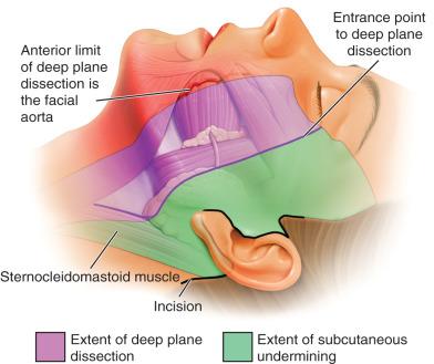 Figure 17.3, Diagrammatic representation of the planes of dissection of the deep plane facelift, with deep plane entry point from the angle of the mandible to the lateral canthus, and in our modification extended for 5 cm below the angle of the mandible.