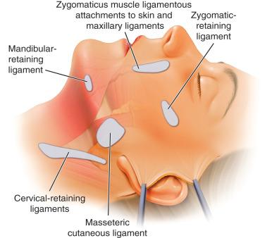 Figure 17.4, Ligamentous attachments released in the extended deep plane facelift include the zygomatic cutaneous ligaments, the maxillary ligaments, the anterior extensions of the masseteric cutaneous ligaments, the cervical-retaining ligaments, and the mandibular cutaneous ligaments.