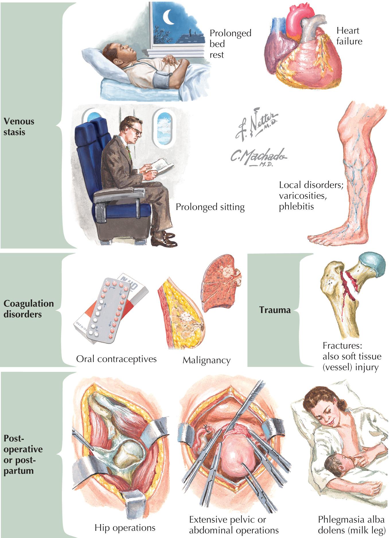 FIG 63.1, Risk Factors for Venous Thrombosis.