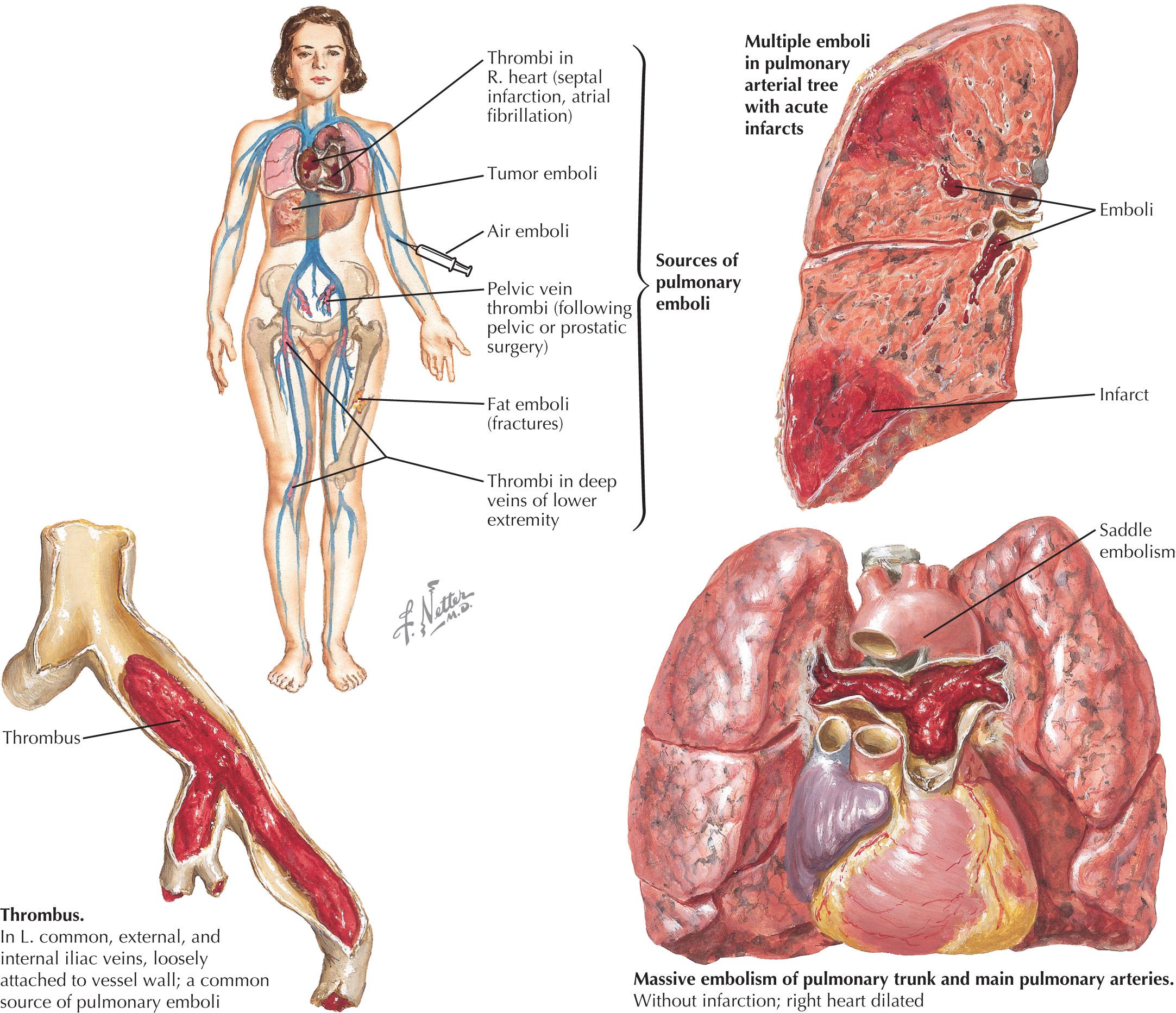 FIG 63.2, Pathogenesis of Acute Pulmonary Embolism.