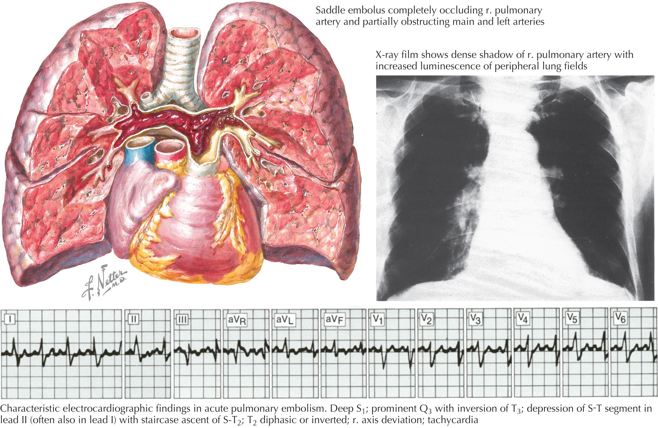 FIG 63.3, Saddle Embolus.