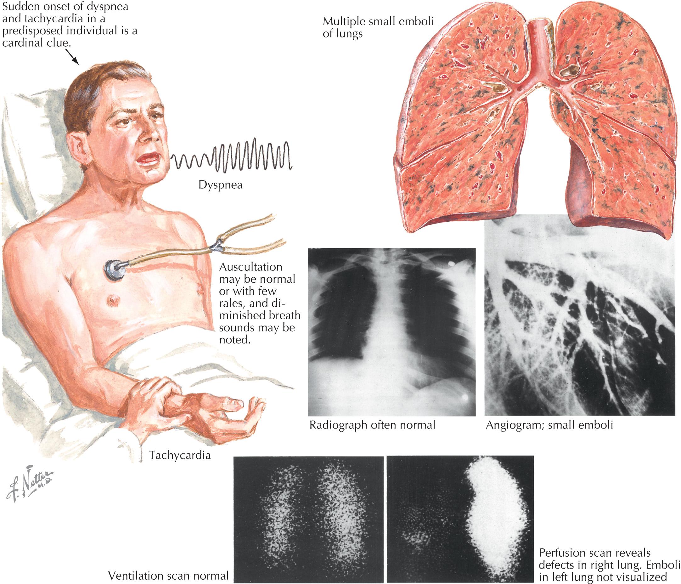 FIG 63.4, Clinical Presentation of Acute Pulmonary Embolism.