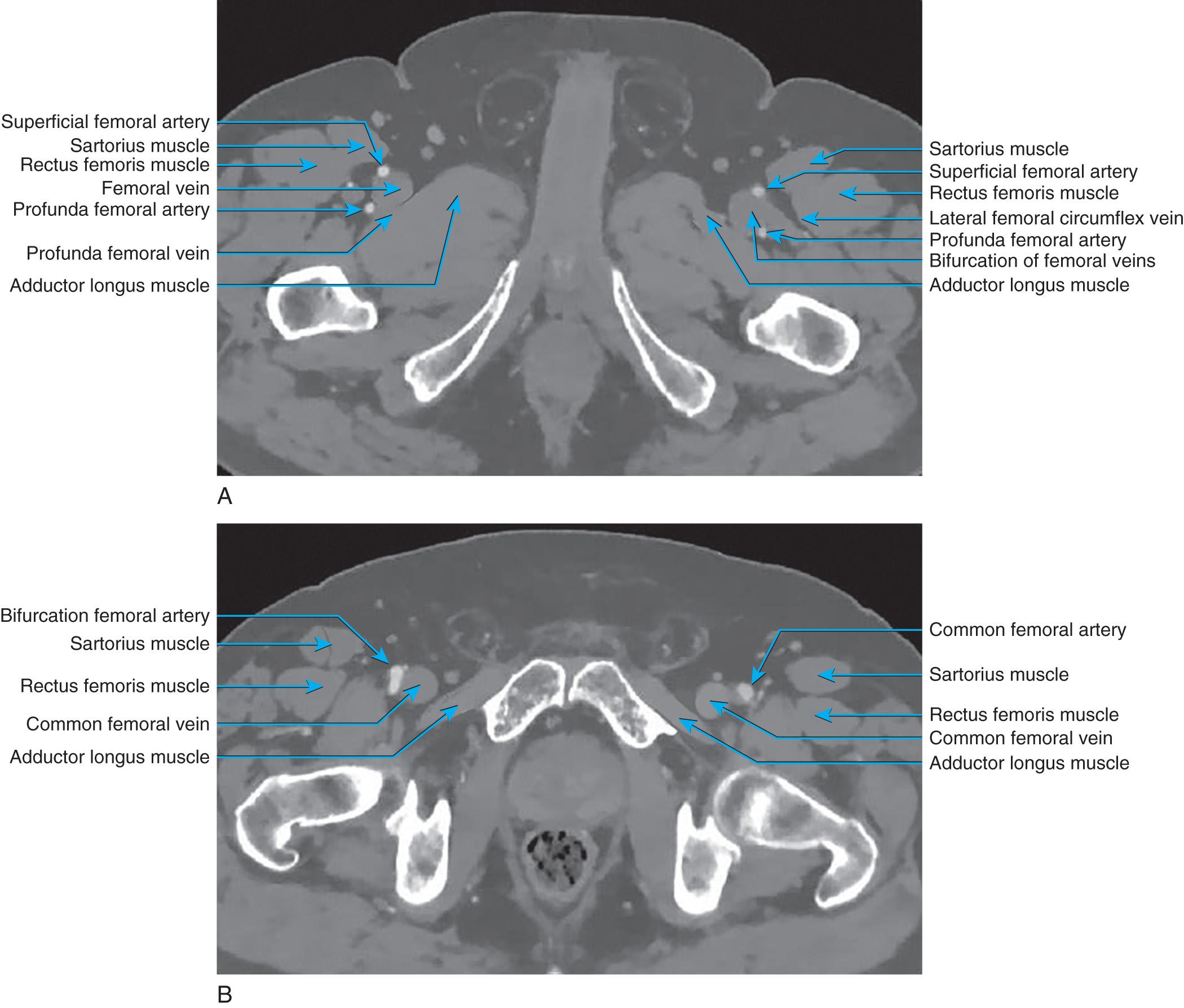 Fig. 19.2, Cross-sectional computed tomography demonstrating anatomy at groin. (A) Caudal. (B) Cephalad.