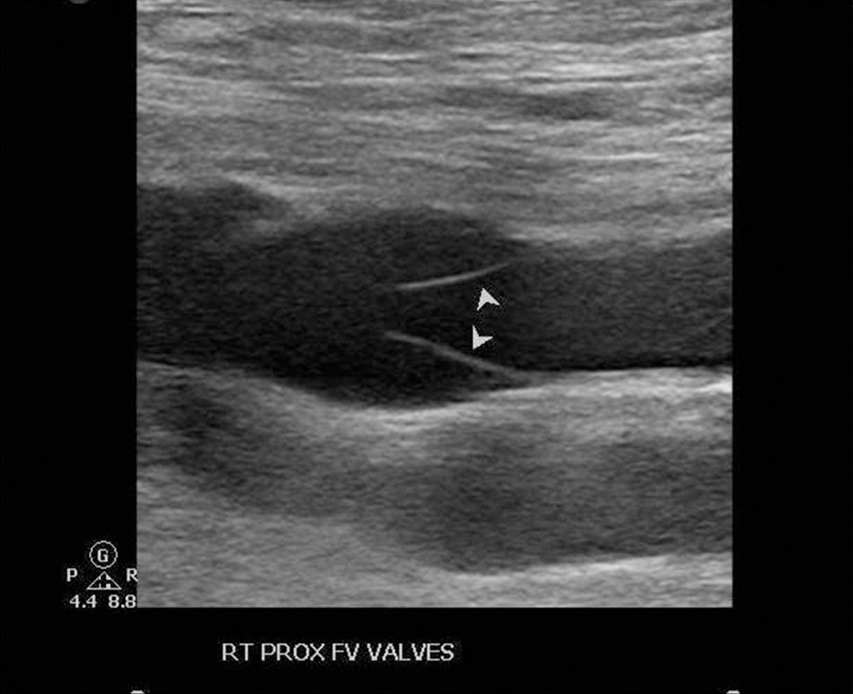 Fig. 19.3, Duplex image of femoral vein valve ( arrowheads show valve leaflets in semi-open position with valve sinuses on opposite side).