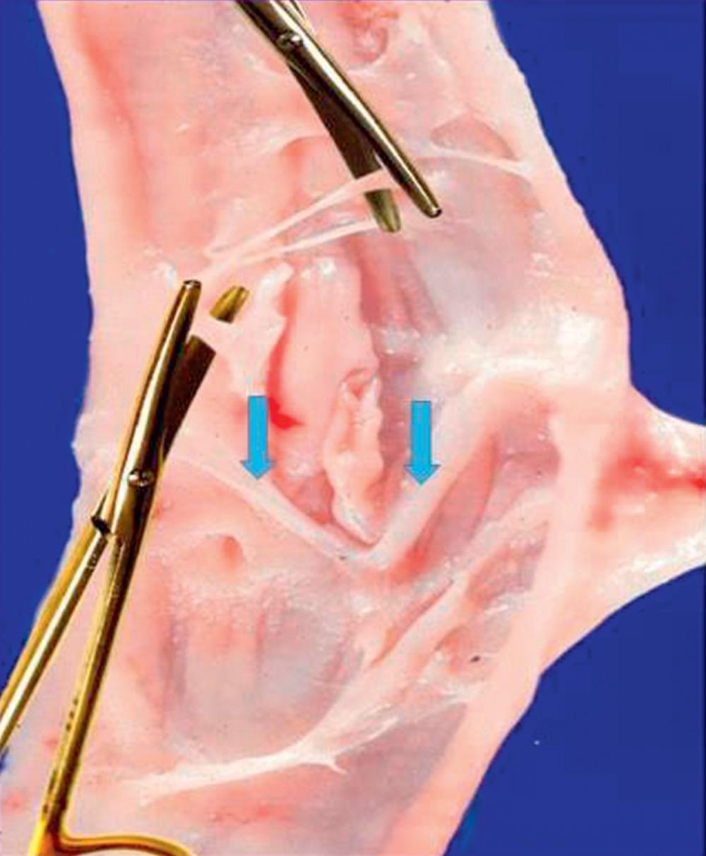 Fig. 19.4, Scarring, webs (being cut), and foreshortening of the valve (arrows) after venous thrombosis and recanalization.