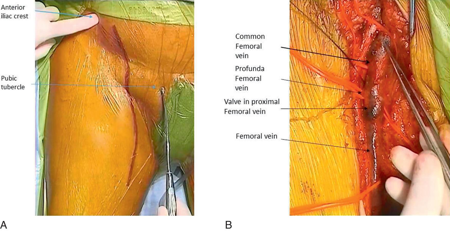 Fig. 19.5, (A) Incision for femoral vein exposure. (B) Femoral vein exposed and branches controlled.