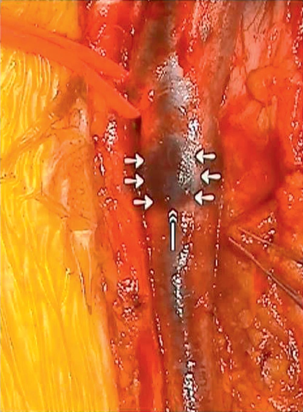 Fig. 19.6, Adventitial dissection allows clear outline of white line of valve attachment to vein wall dissected before vein opening (note double-headed arrow is bottom of valve attachment; other arrows outline valve attachment from outside vein).