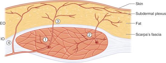 Figure 57.2, Axial cut through the rectus abdominis showing the different branching patterns of the DIEA. 1, Branch directed to muscle only; 2, branch directed mostly to muscle; 3, branch directed mostly to skin; 4, fasciocutaneous perforator. EO, external oblique; IO, internal oblique.