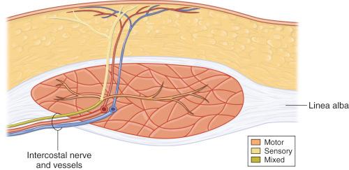 Figure 57.4, Axial view through right rectus abdominis showing the typical course of a segmental intercostal nerve.