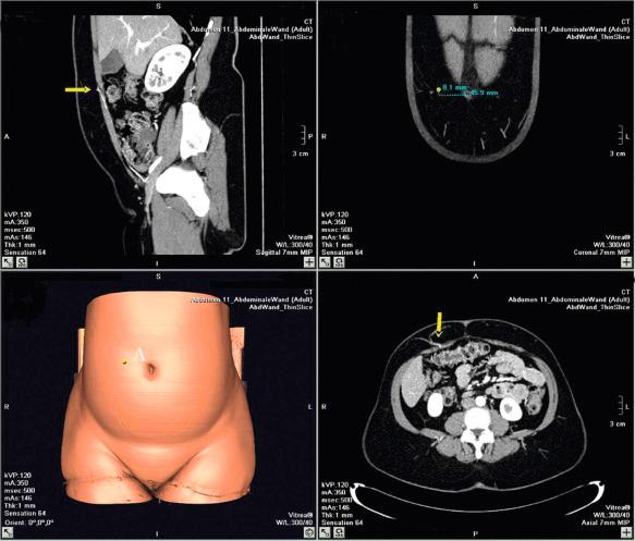 Figure 57.5, Preoperative investigation of abdominal wall vessels using multidetector CT scan.