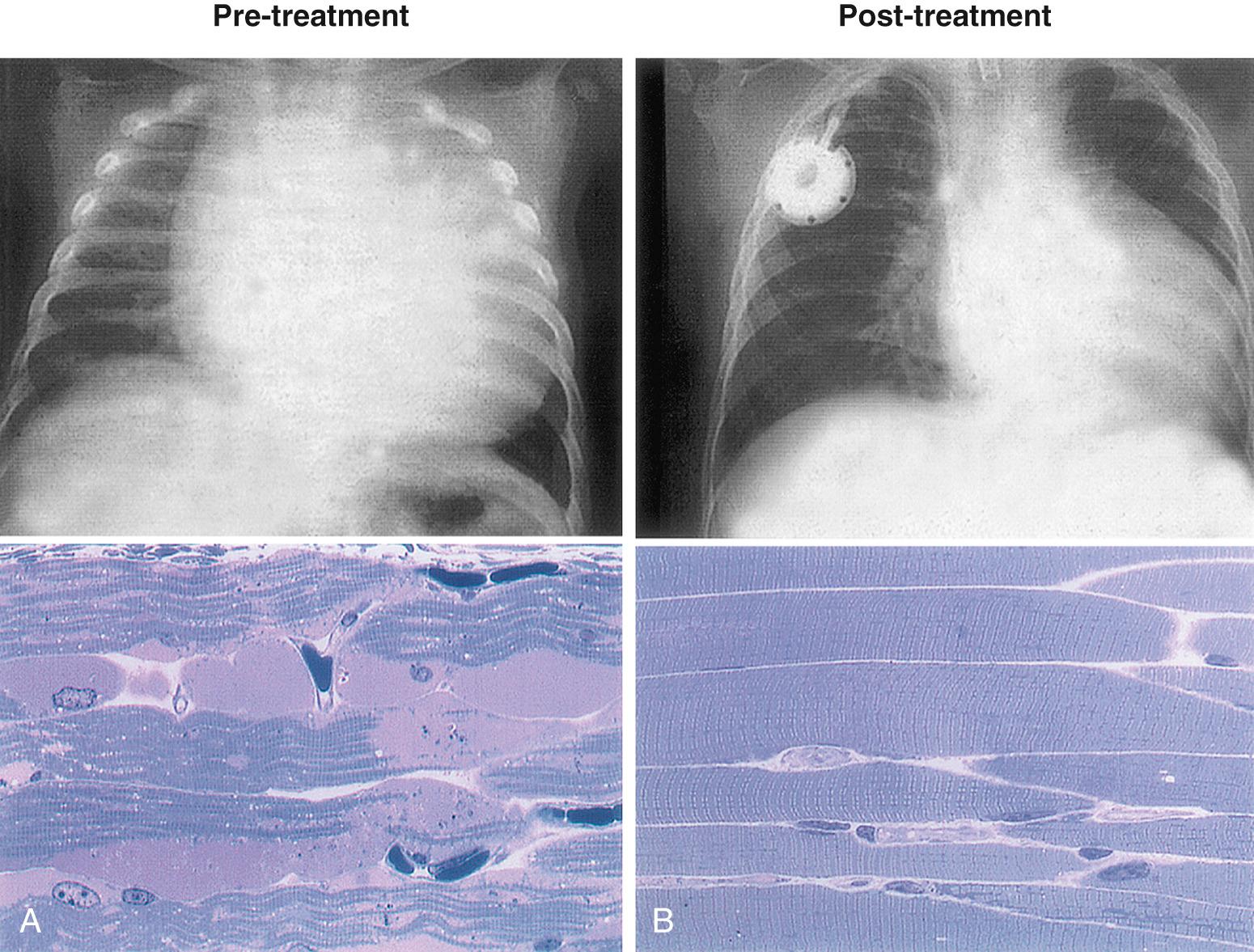 Fig. 105.3, Chest radiograph and muscle histology findings of an infantile-onset Pompe disease patient before ( A ) and after ( B ) enzyme replacement therapy. Note the decrease in heart size and muscle glycogen with the therapy.