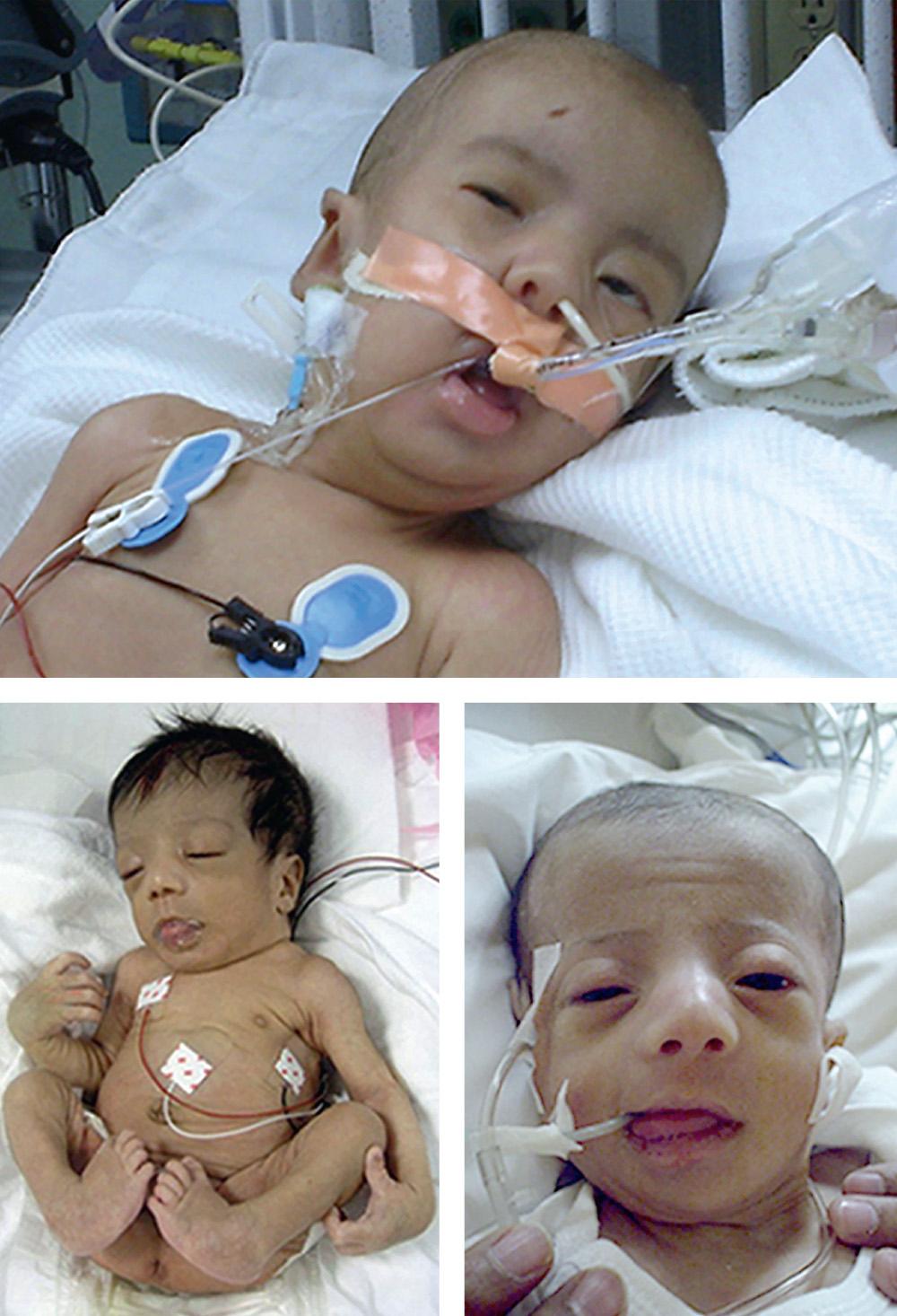 Fig. 104.3, Zellweger syndrome.