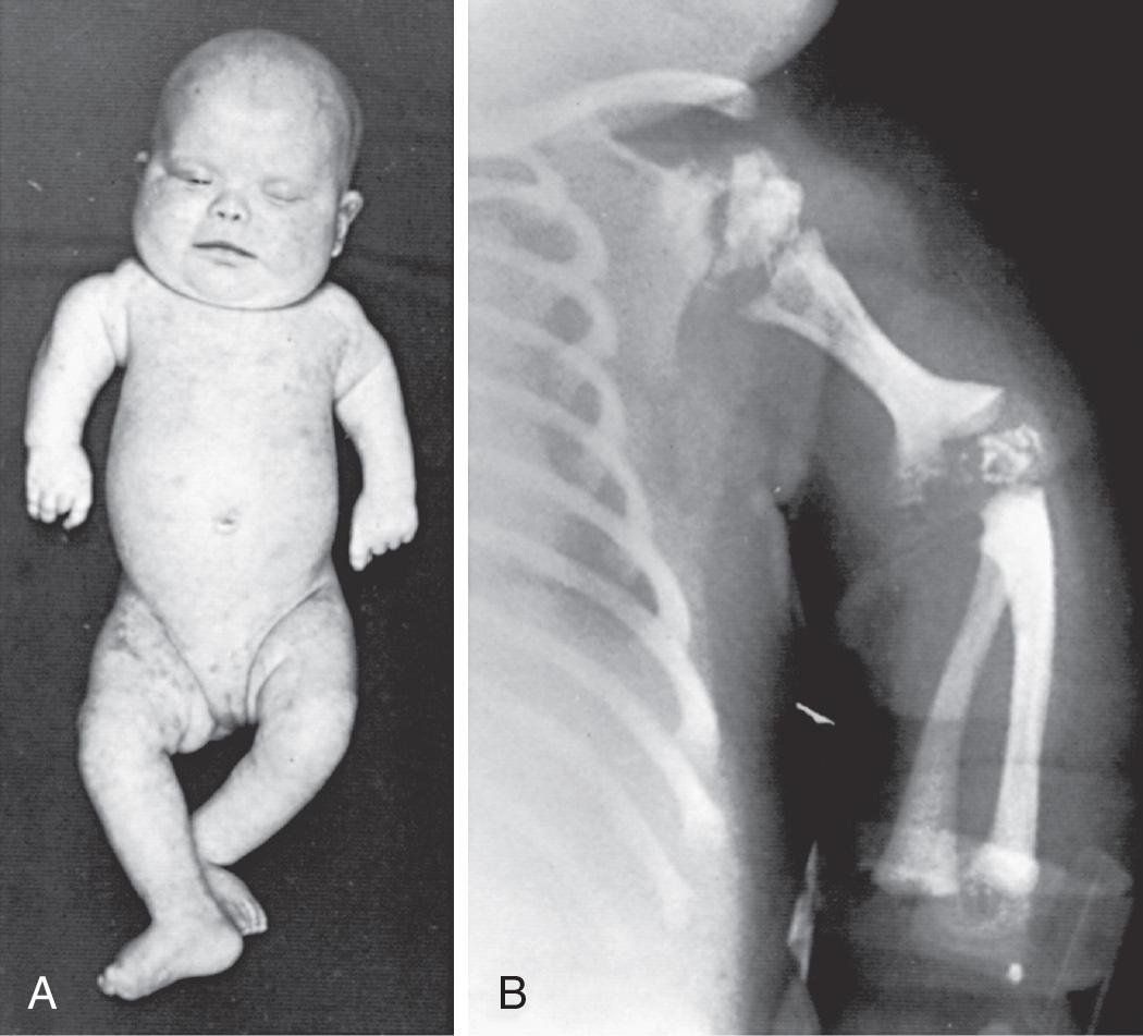 Fig. 104.4, A, Newborn infant with rhizomelic chondrodysplasia punctata. Note the severe shortening of the proximal limbs, the depressed bridge of the nose, hypertelorism, and widespread scaling skin lesions. B, Note the marked shortening of the humerus and epiphyseal stippling at the shoulder and elbow joints.